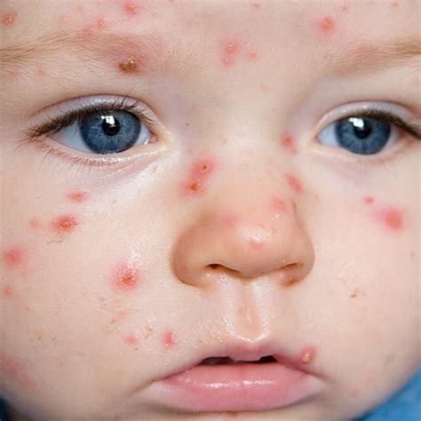The classic symptom of chickenpox is an uncomfortable, itchy rash. . Lija e ujit beba ime